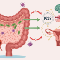 An educational guide illustrating the connection between gut health and PCOS, highlighting how microbiome balance impacts female hormones.