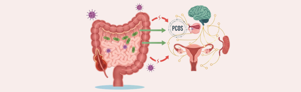 An educational guide illustrating the connection between gut health and PCOS, highlighting how microbiome balance impacts female hormones.